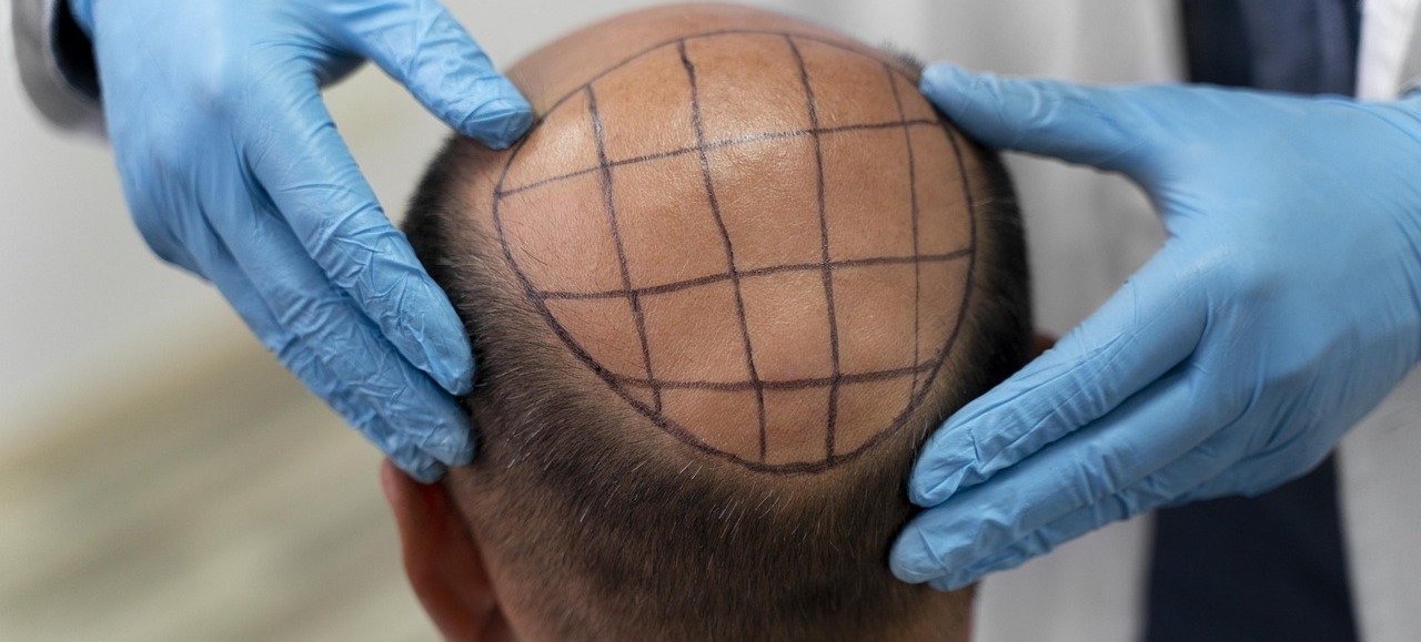 Cómo tratar la alopecia. Foto: Pixabay