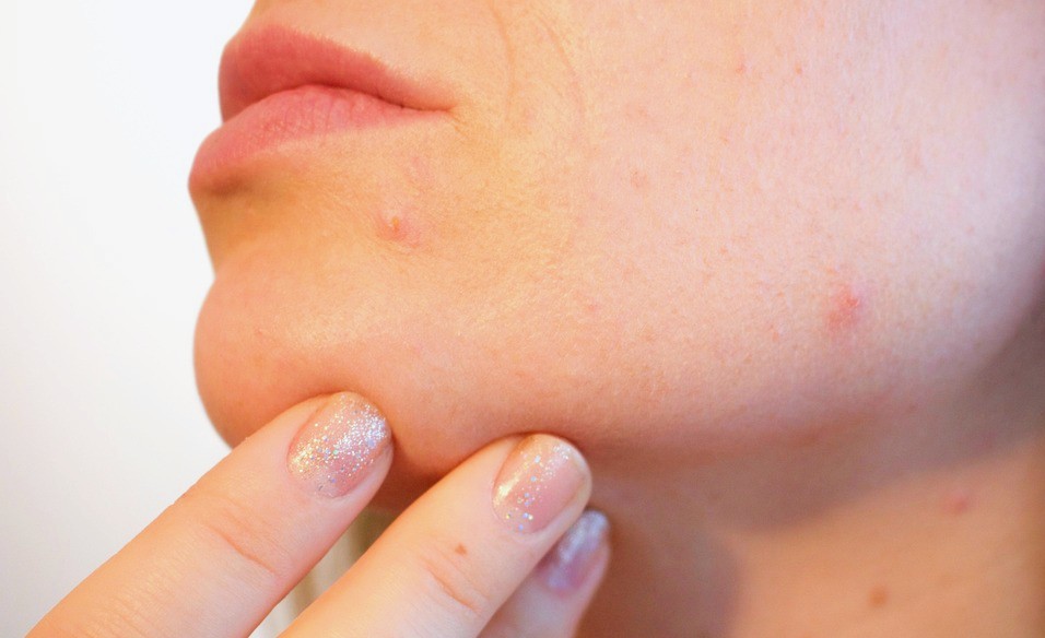 acne-1606765_12802 La piel de la mujer "habla": ¿qué nos dice en cada etapa?